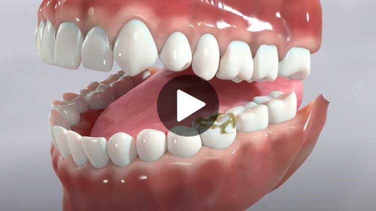 A thumbnail for an educational video on cavities